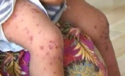 61 Anak di Surabaya Terjangkit Flu Singapura