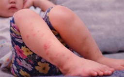 Baca juga : Dinkes Surabaya Bagikan Tips Hindari Penyakit Flu Singapura