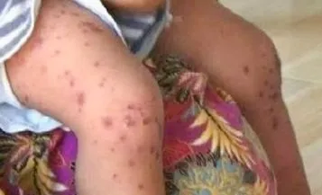 61 Anak di Surabaya Terjangkit Flu Singapura